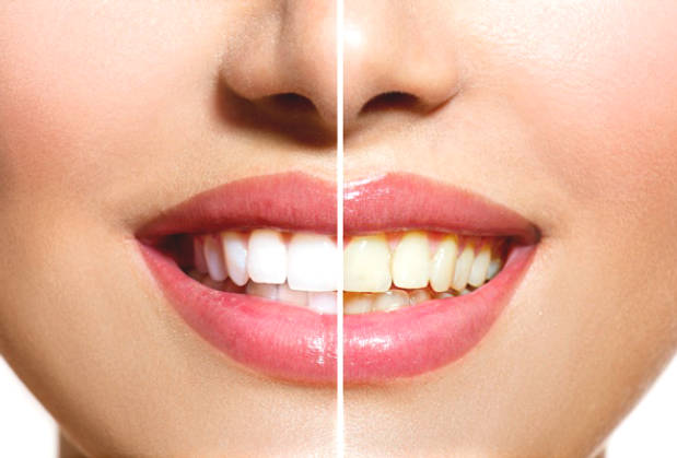 7 simple ways to whiten teeth naturally at home
