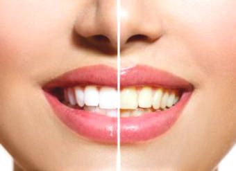 7 simple ways to whiten teeth naturally at home